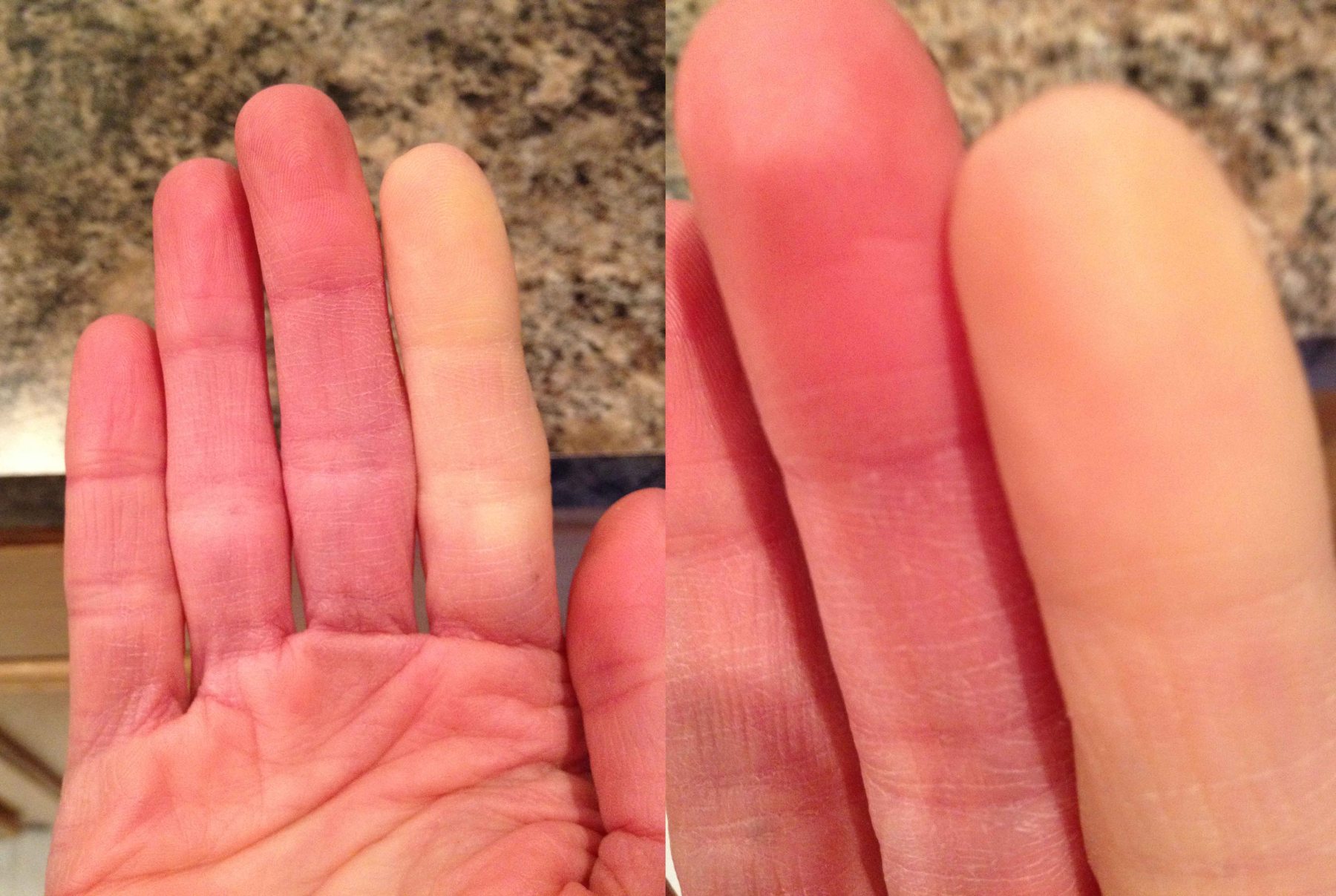 What Is Raynauds Disease Diagnosing And Treating Dr Nicholas