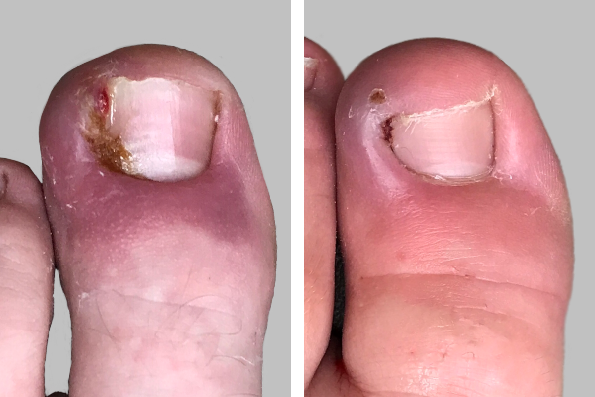 Before And After Photos Akron Podiatrist Dr Nicholas Campitelli Dr Nicholas Campitelli