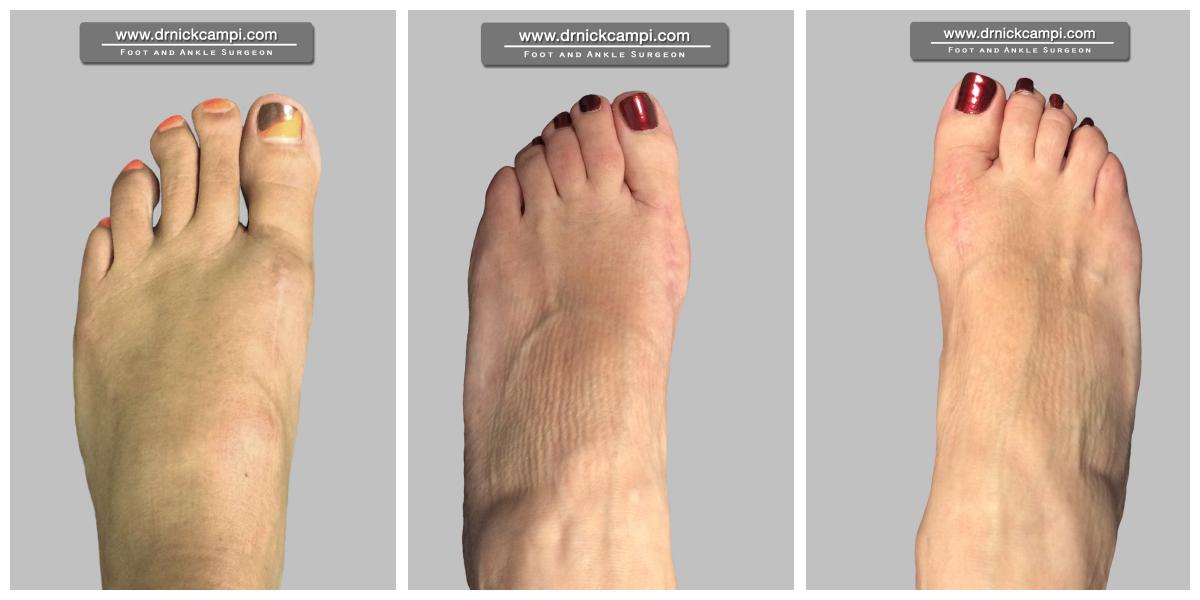 Before And After Photos Akron Podiatrist Dr Nicholas Campitelli