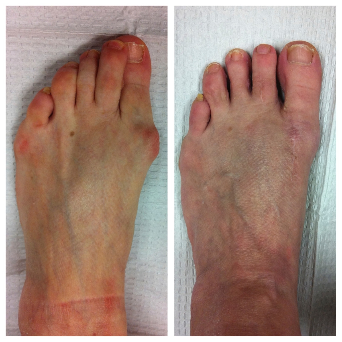 Before And After Photos Akron Podiatrist Dr Nicholas Campitelli