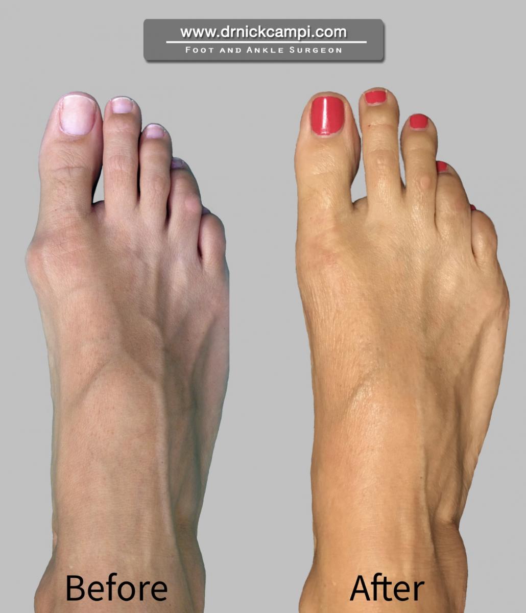 How To Treat Bunions – Dr. Nicholas Campitelli