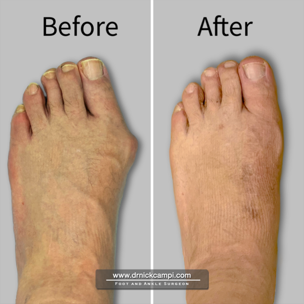 Before And After Photos Akron Podiatrist Dr Nicholas Campitelli