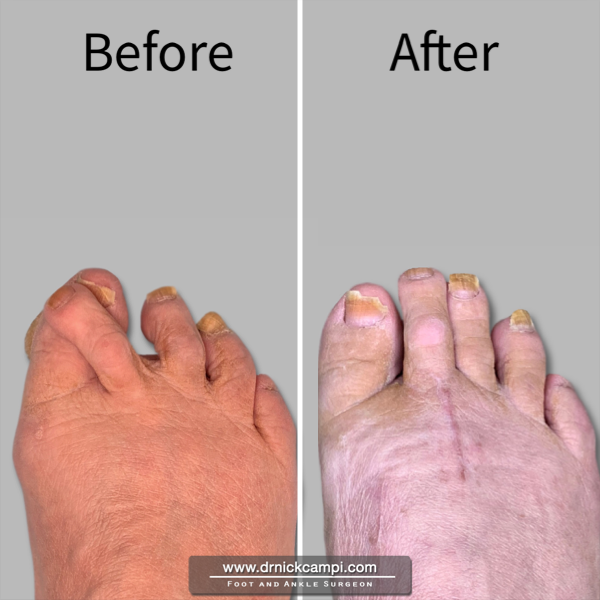 Before And After Photos Akron Podiatrist Dr Nicholas Campitelli