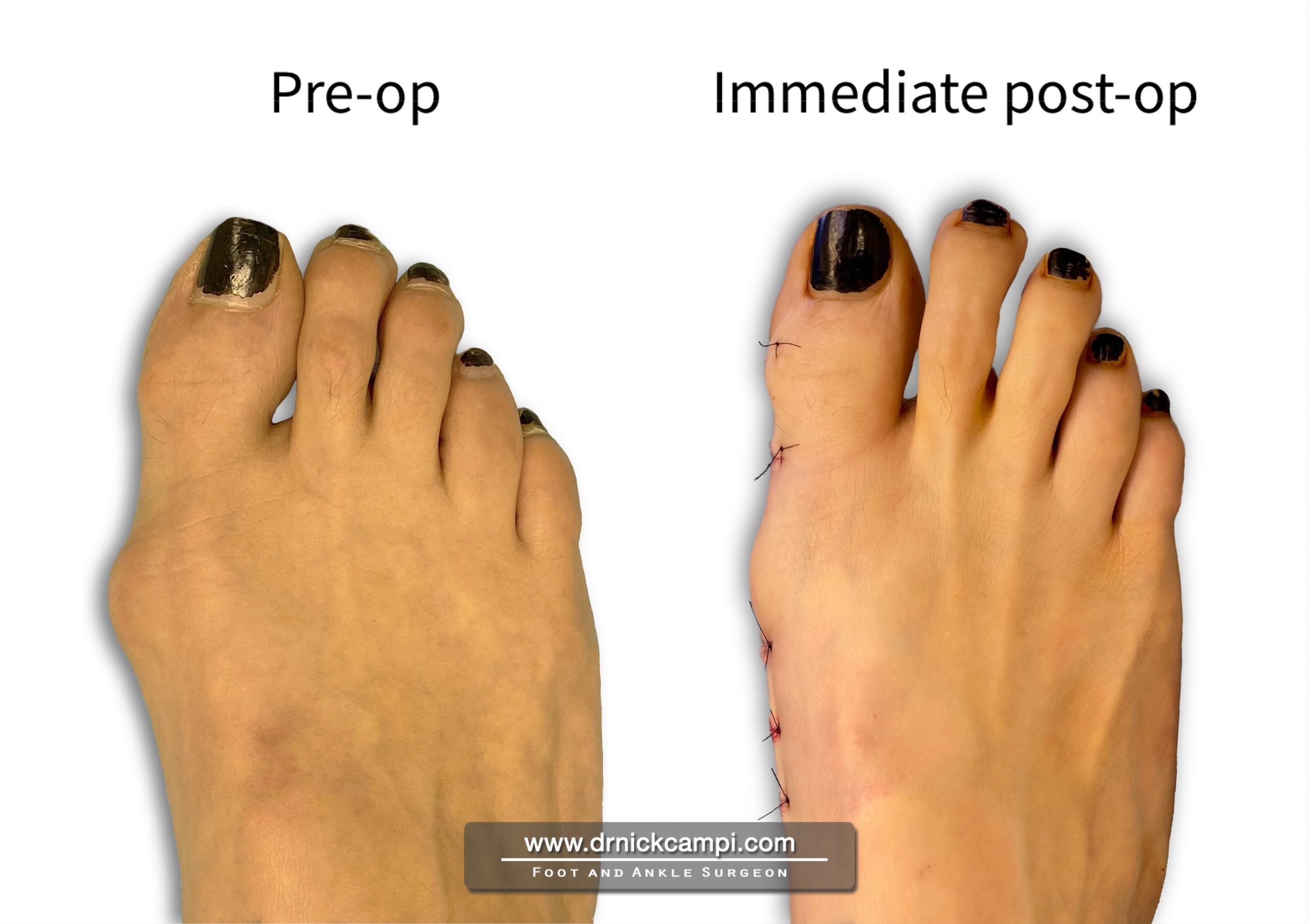 Minimally Invasive Bunion Surgery In Akron, OH | Dr. Nicholas ...