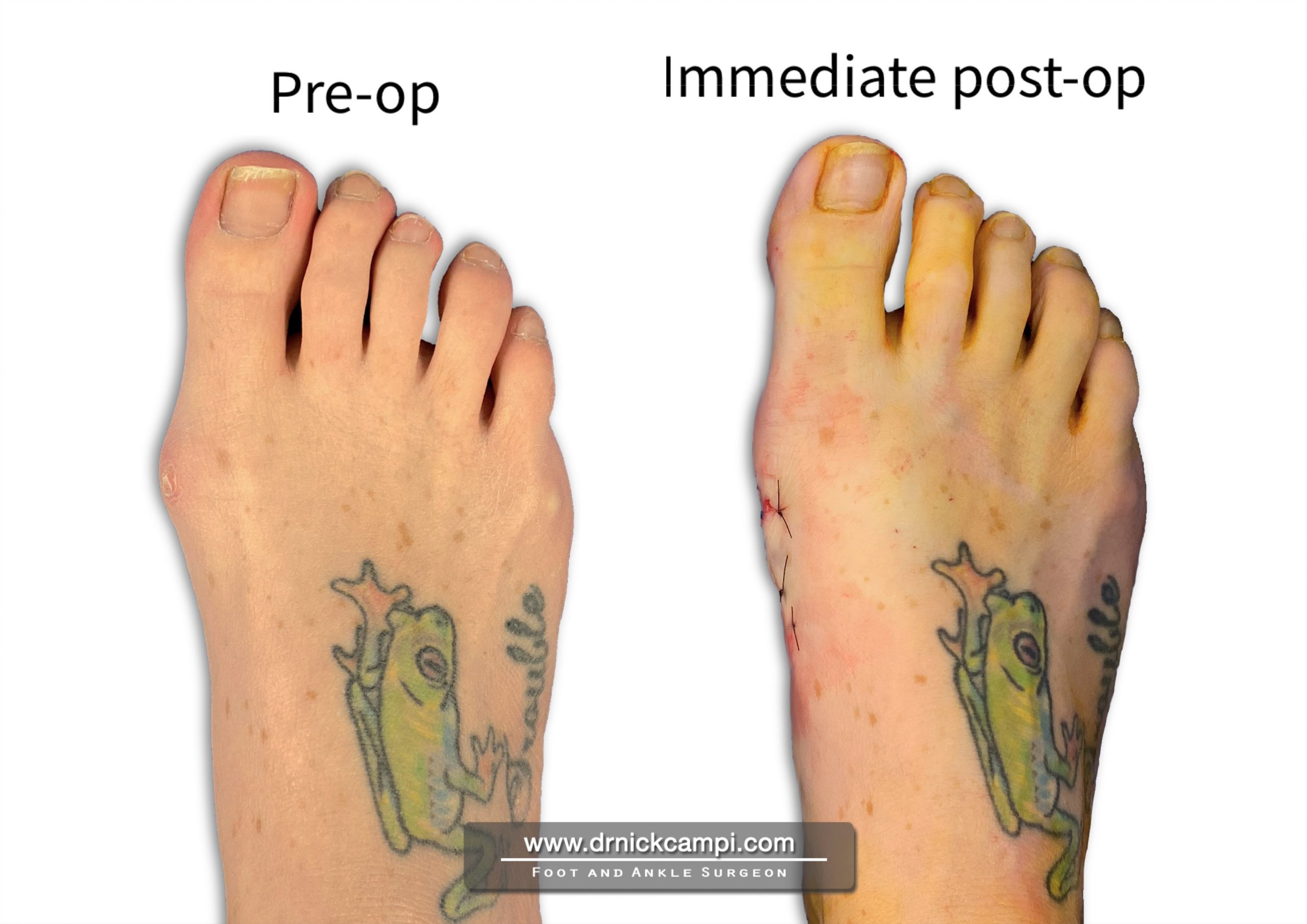 Before And After Photos Akron Podiatrist Dr Nicholas Campitelli