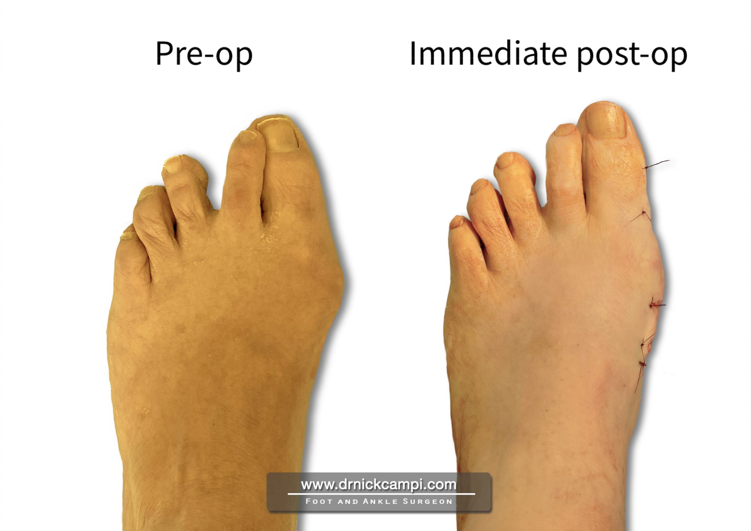 Before And After Photos Akron Podiatrist Dr Nicholas Campitelli