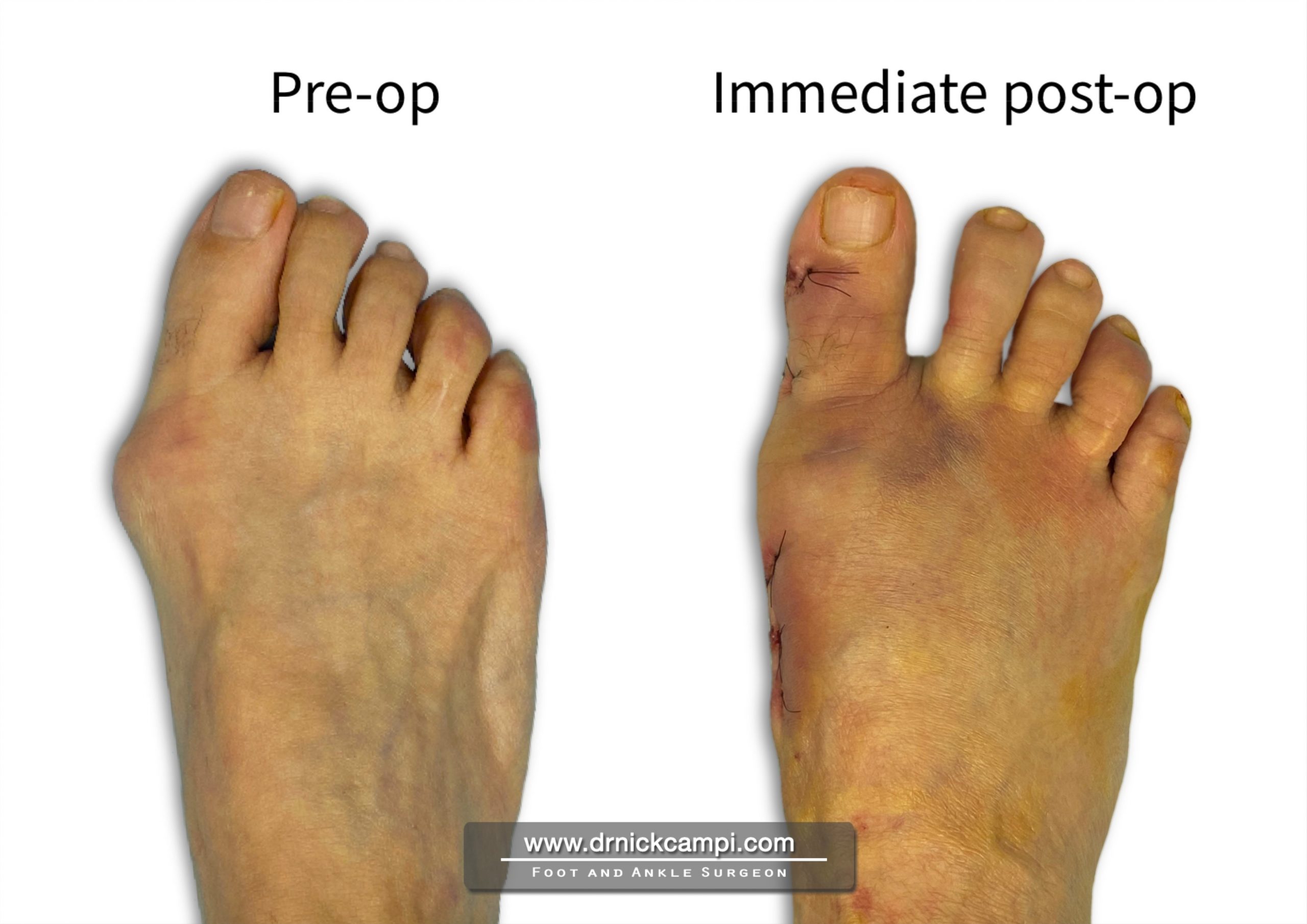 Before And After Photos Akron Podiatrist Dr Nicholas Campitelli