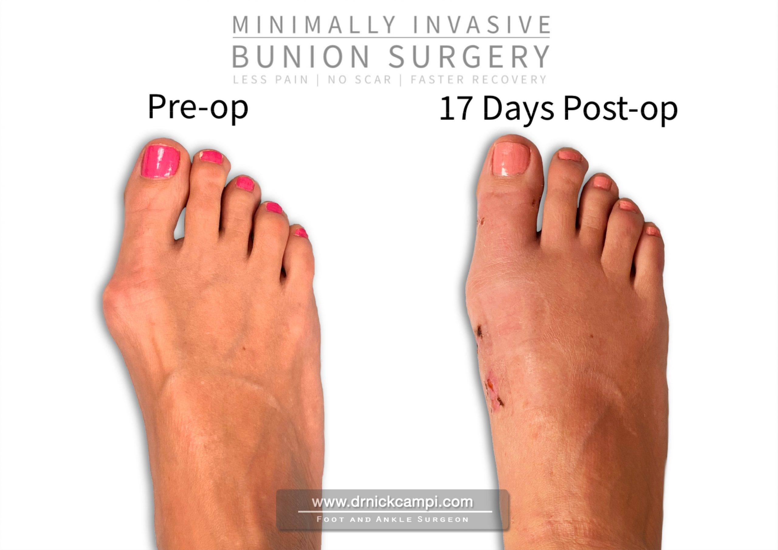 Before And After Photos | Akron Podiatrist | Dr. Nicholas Campitelli ...