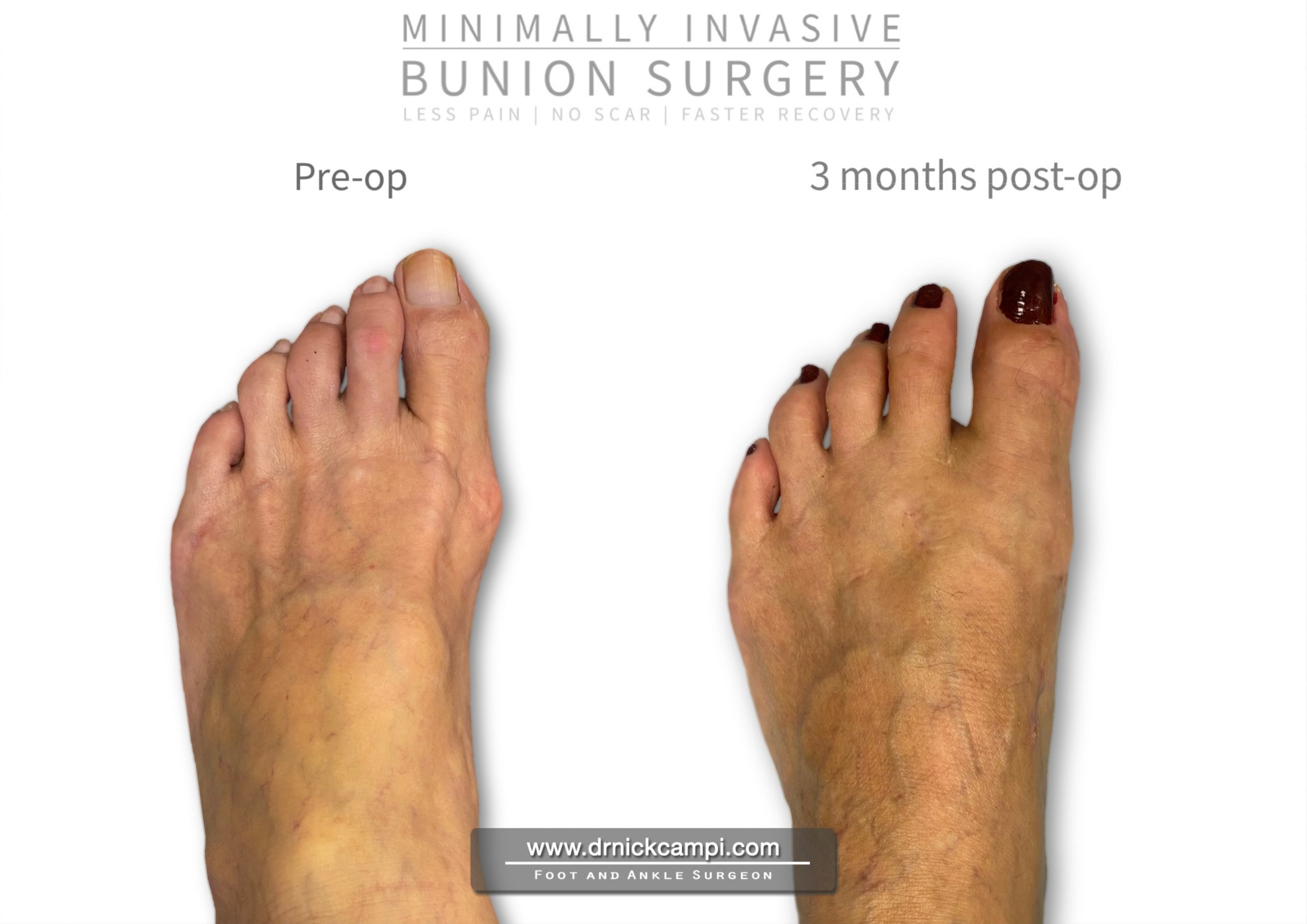 Before And After Photos Akron Podiatrist Dr Nicholas Campitelli Dr Nicholas Campitelli