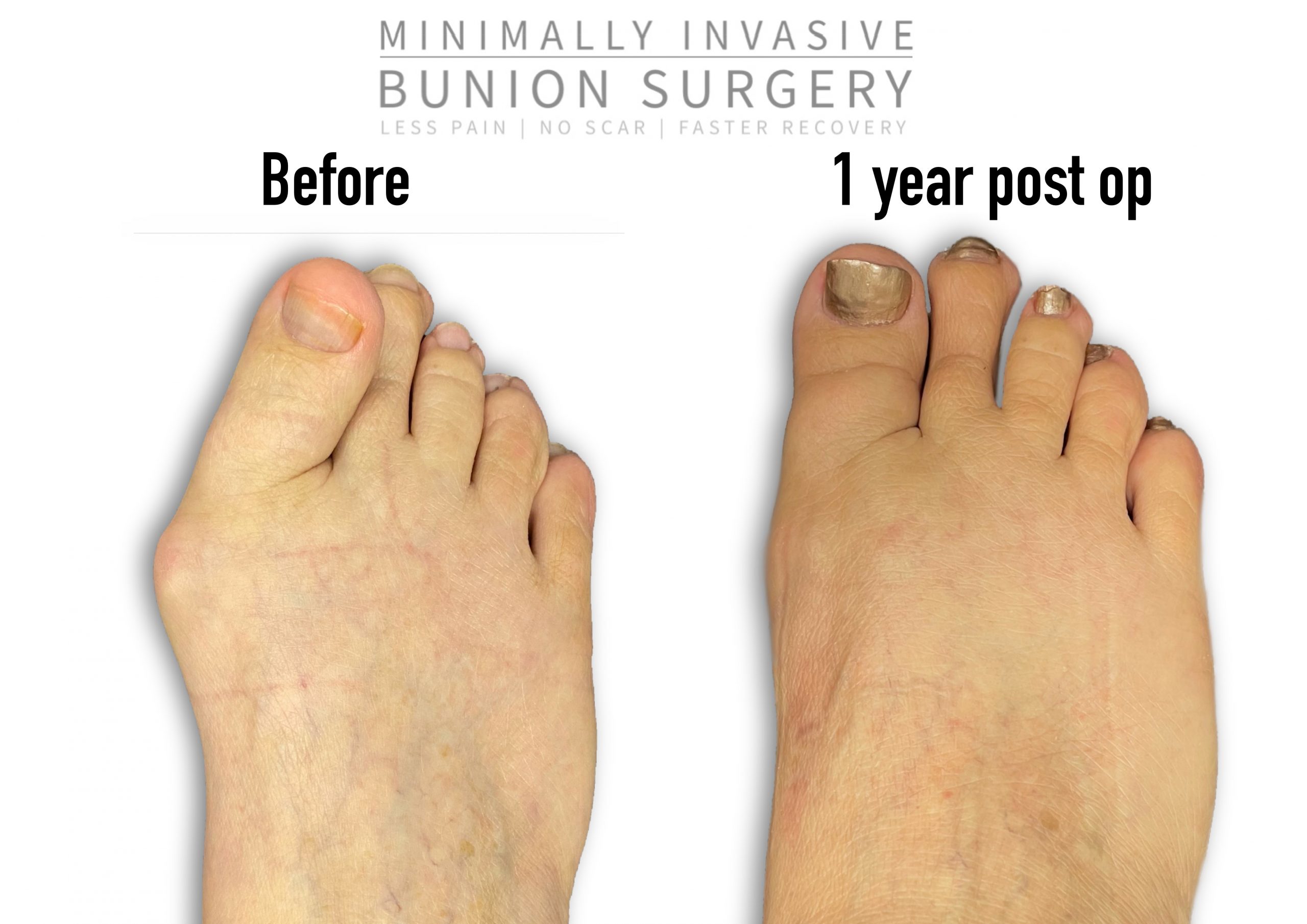 Before And After Photos Akron Podiatrist Dr Nicholas Campitelli